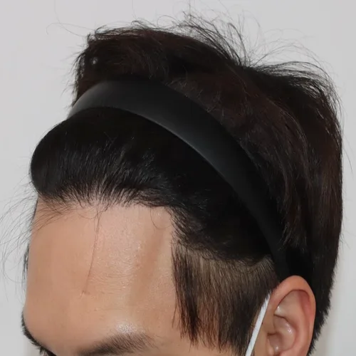 모발이식 절개 방식